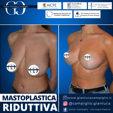 Dr. Gianluca Campiglio |  Mastoplastica RIDUTTIVA Milano